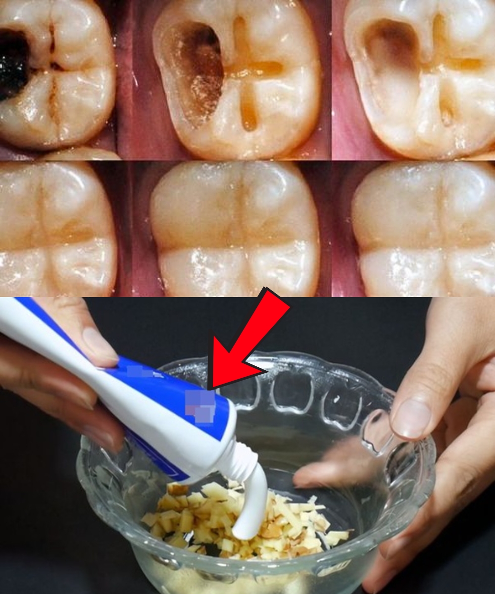 Heal Cavities Naturally and Strengthen Your Teeth – Here’s How!