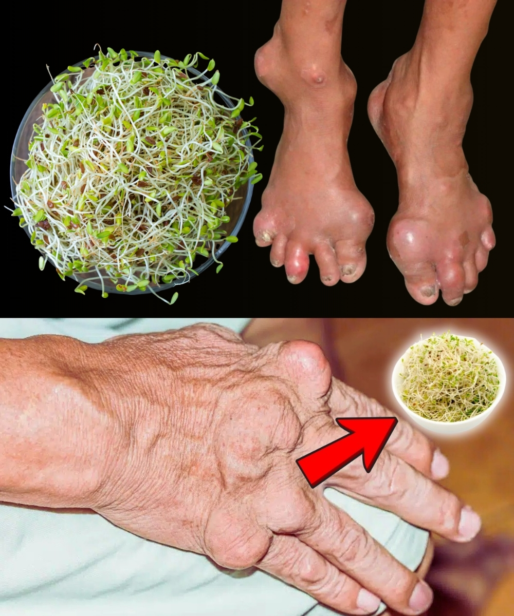 Say Goodbye to Kidney Stones & Gout Naturally: The Amazing Benefits of Alfalfa