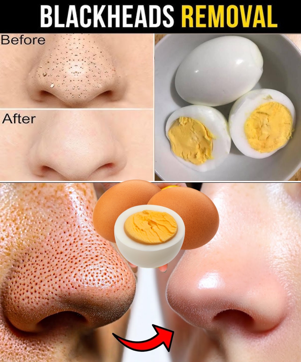 Say Goodbye to Blackheads with Just One Egg – Here’s How!