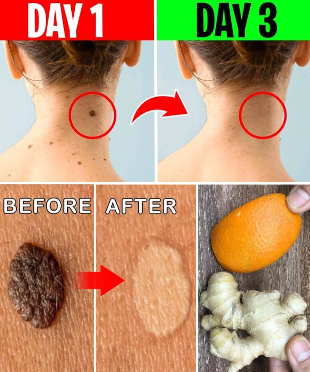 Say Goodbye to Skin Tags in Just 3 Days with Ginger & Orange Peel!