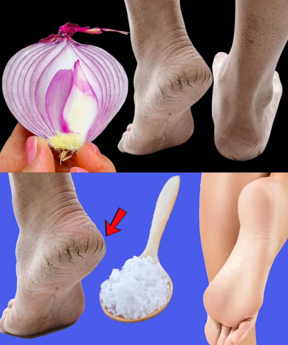5 Natural Home Remedies for Cracked Heels That Actually Work – Say Goodbye to Dry, Painful Feet!