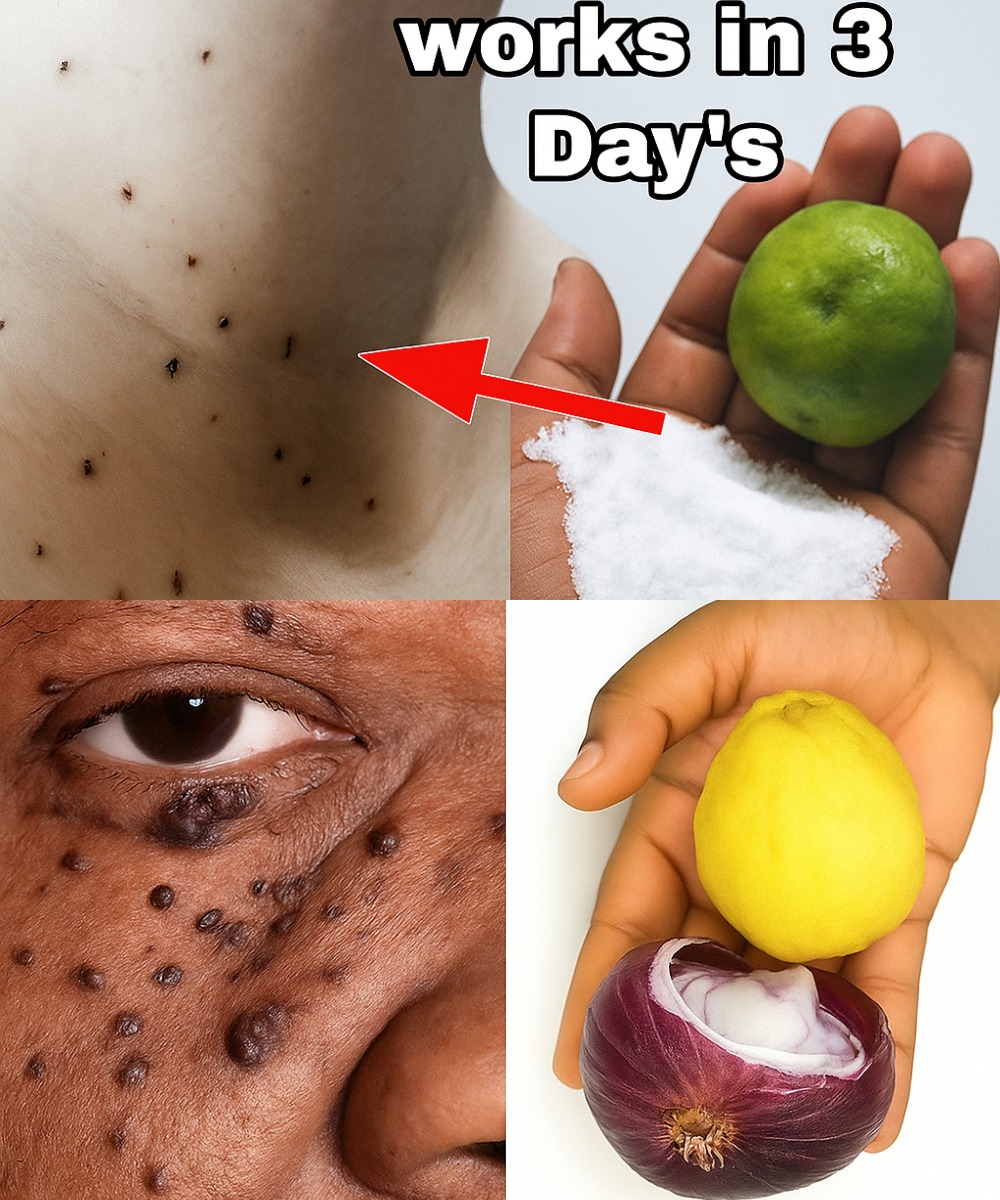 Lemon Magic: Remove Skin Tags Naturally in Just 3 Days!